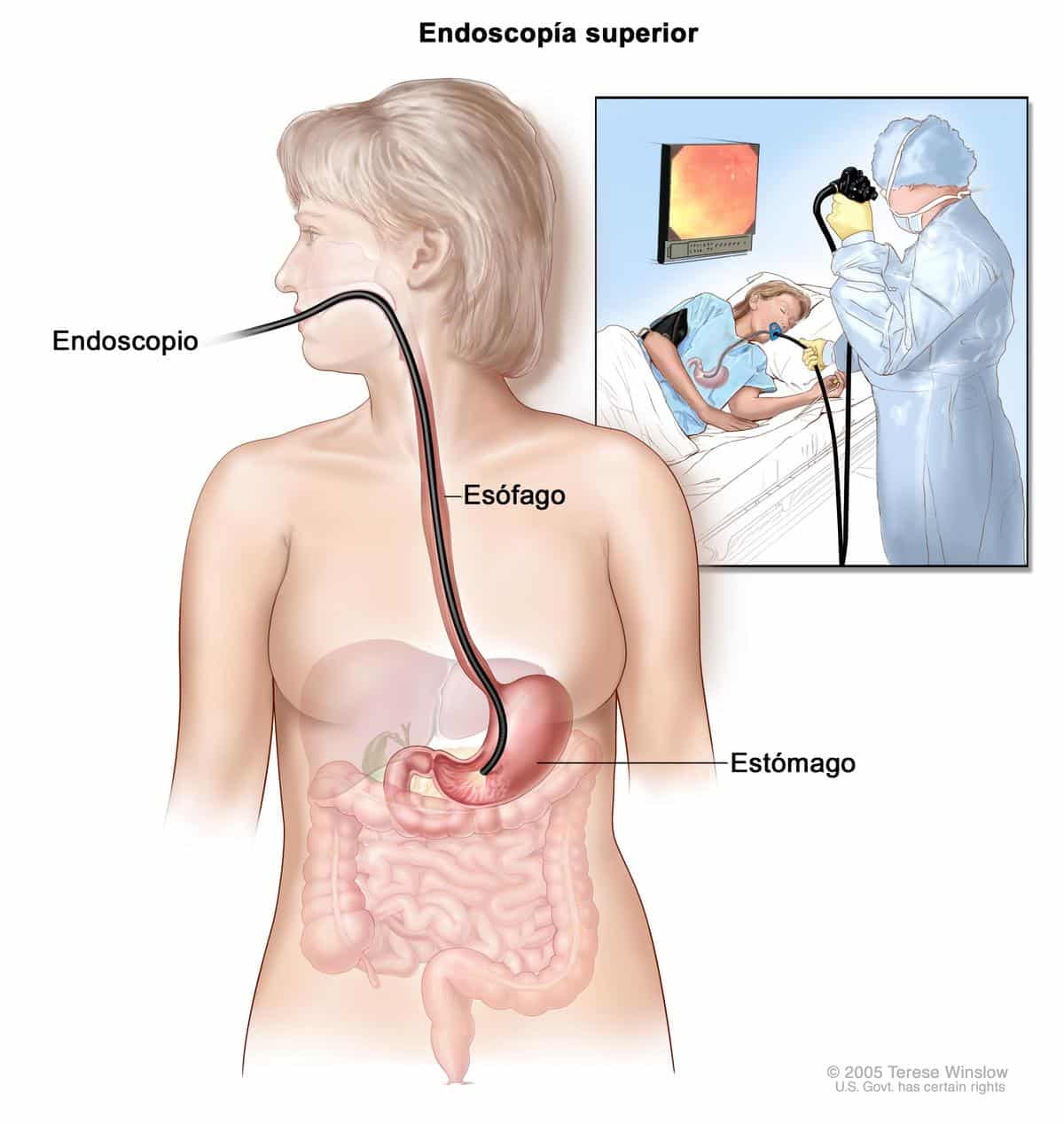 La endoscopia de las vías digestivas altas ayudará a conocer la causa de su dolor en la boca del estómago