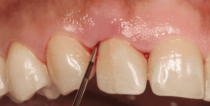 El sangrado de encías se hace evidente al cepillarse los dientes o al comprimir la encía