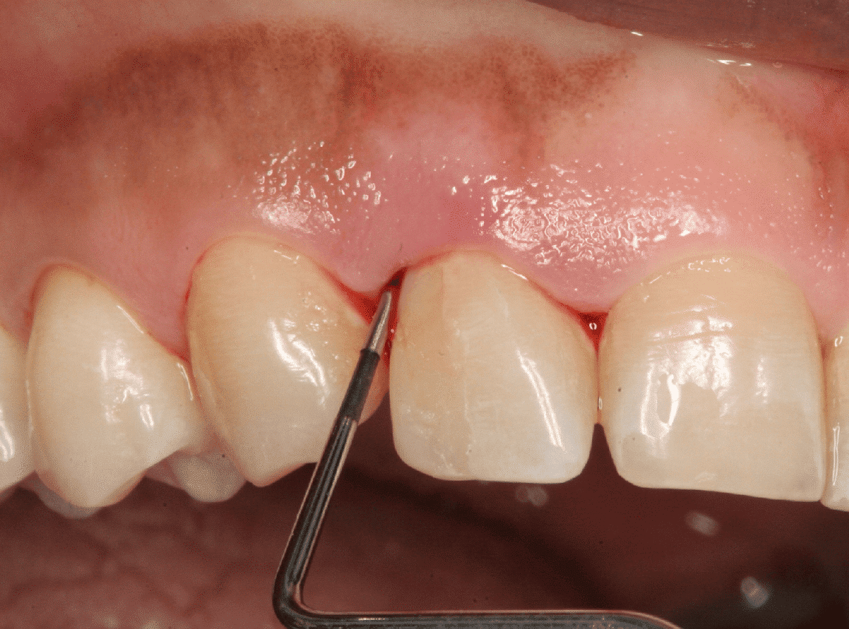 El sangrado de encías se hace evidente al cepillarse los dientes o al comprimir la encía
