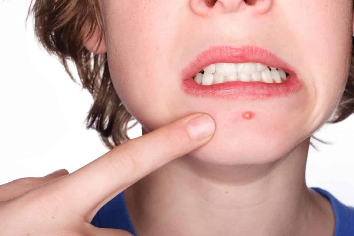 Cómo quitar granos y otras manifestaciones del acné