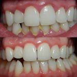 4-Gingivitis-before-and-after-3