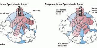Hay una fuerte conexión entre la respiración bucal y el asma