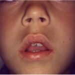 Deformaciones anatómicas en niños que padecen de respiración bucal