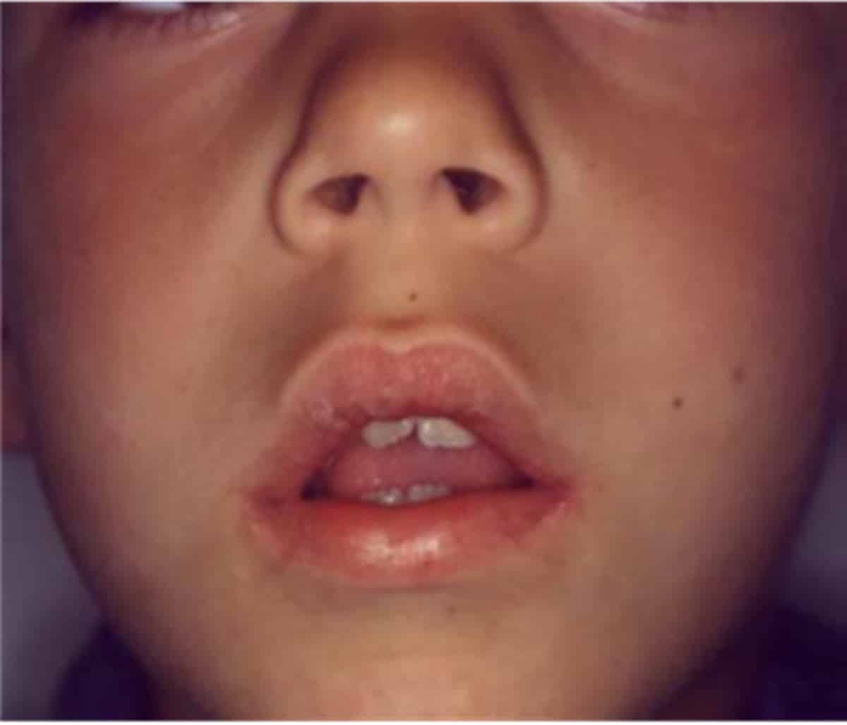 La respiración bucal determina deformaciones anatómicas