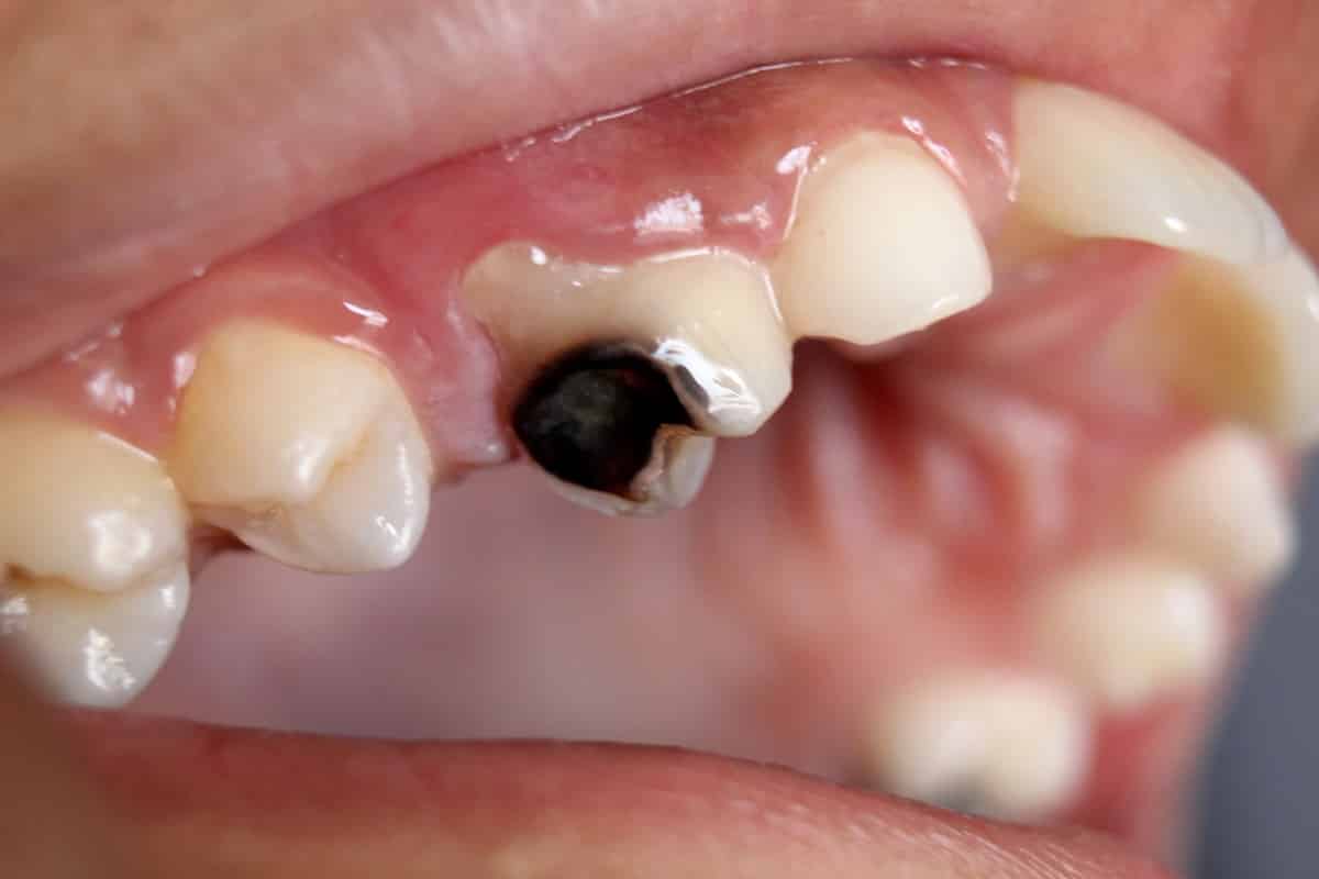 La respiración bucal favorece las caries dentales