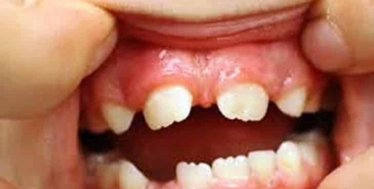 Entre las complicaciones que ocasionan los dientes supernumerarios se encuentran las diastemas