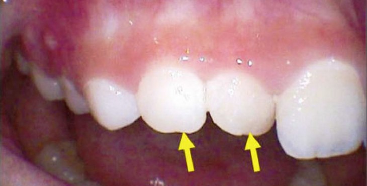El tener un diente supernumerario se le denomina hiperdoncia
