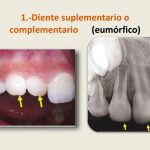 Imagen radiologica de dientes supernumerarios