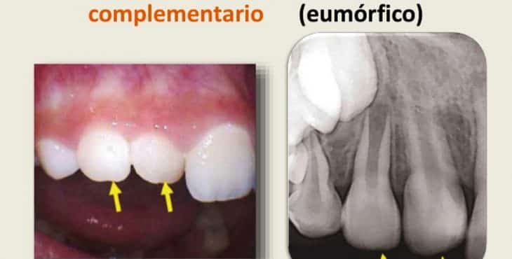 En los estudios radiológicos aparecen frecuentemente los dientes supernumerarios