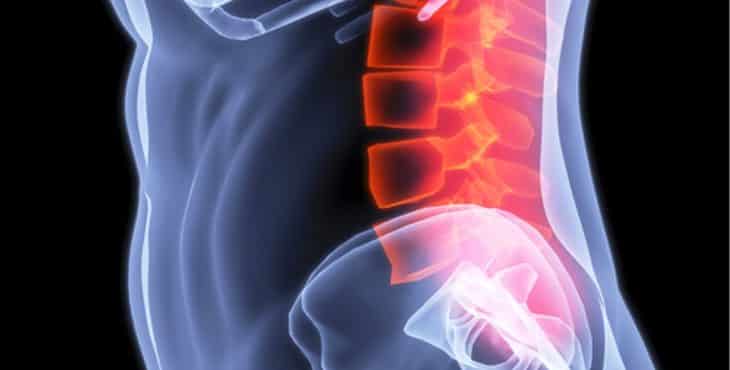 La sacrolumbalgia puede referirse como el dolor que aparece en la parte baja de la espalda