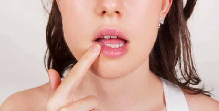 tratamientos naturales para el herpes labial