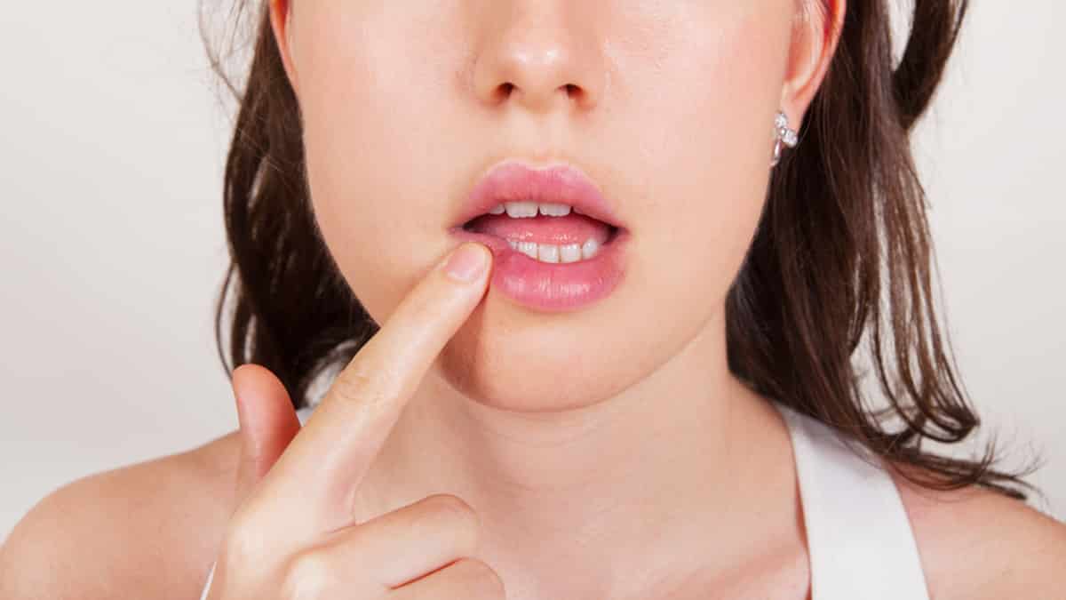El herpes labial y su tratamiento natural