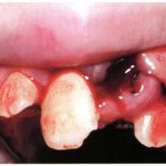 Consecuencias de la avulsión de dientes por traumatismo