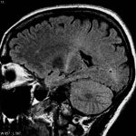 Daño en el cerebro en la esclerosis lateral amiotrófica