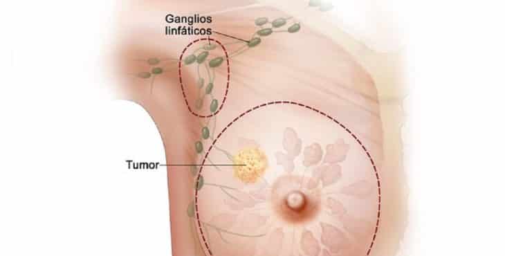 Los diferentes tipos de cáncer requieren de una conducta particular