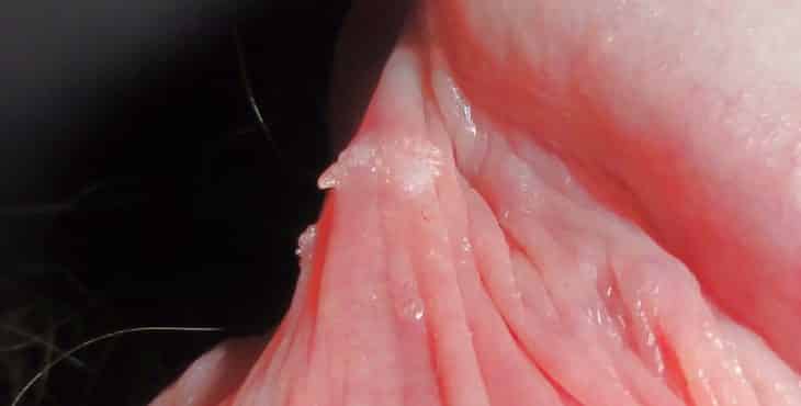 Verruga genital en el pene