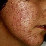 Problema de acné