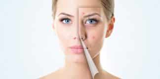Remedios caseros para eliminar el acné
