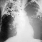 Rayos X de una persona afectada con tuberculosis