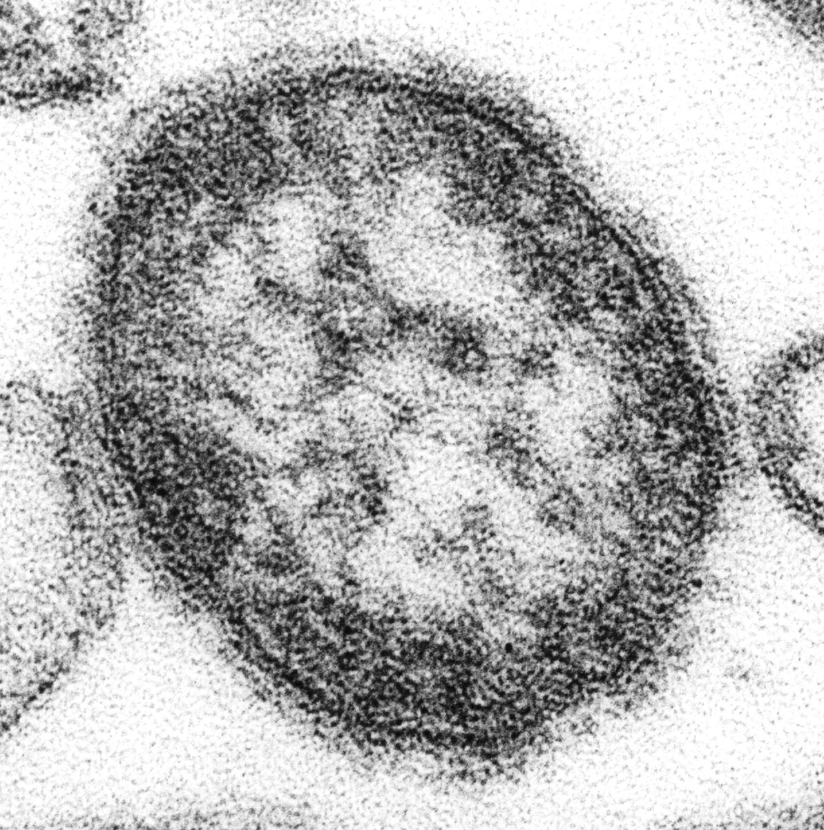 El sarampión es causado por un virus