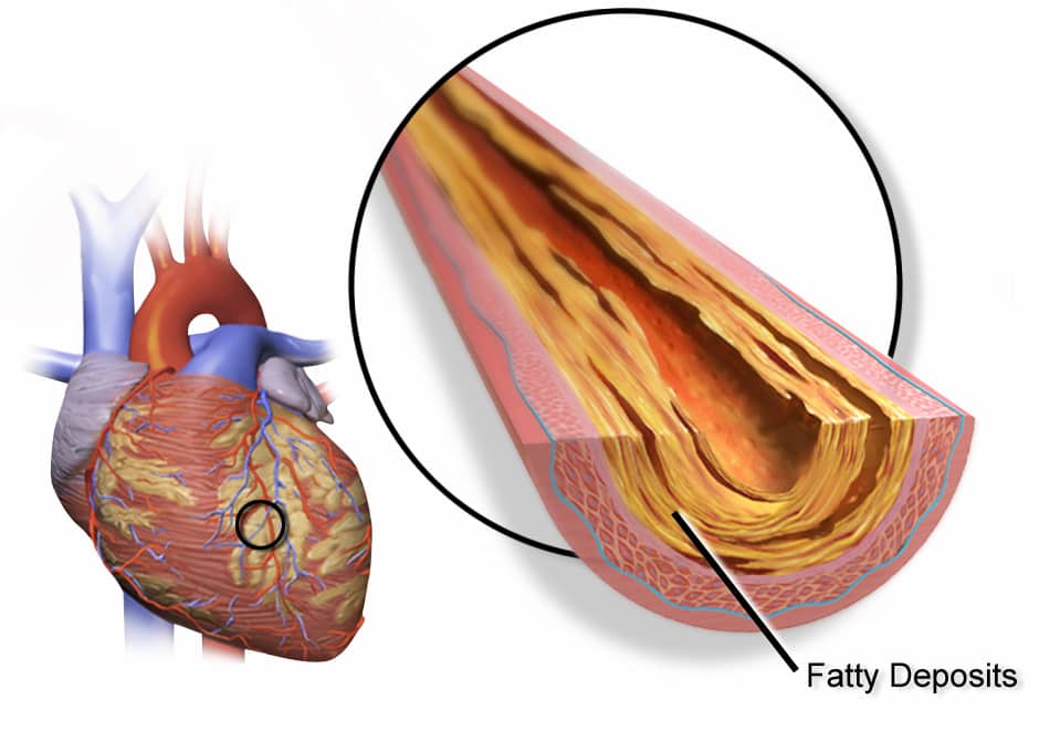 colesterol y ateroma