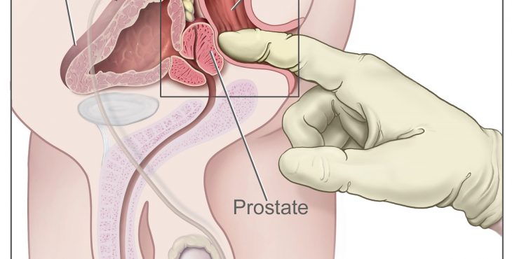 Entre los tipos de cáncer más frecuentes se encuentra el cáncer de próstata