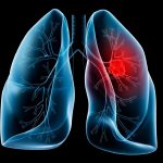 cancer de pulmon