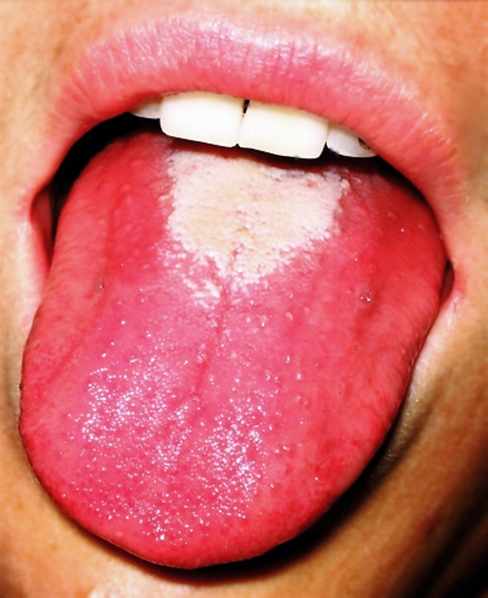 Lengua en fresa característica de la fiebre escarlatina