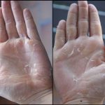 Descamacion tipica de las manos