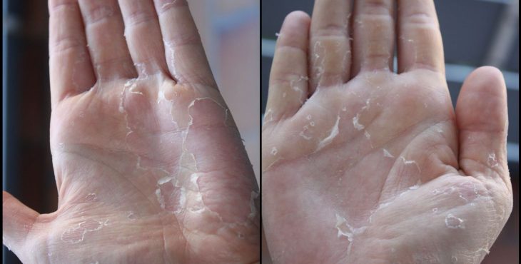Uno de los signos de escarlatina es la descamación de manos y pies