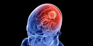 Cerebro y zonas afectadas por lla enfermedad de Parkinson