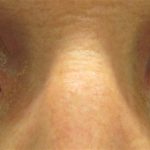 La conjuntivitis hemorrágica provoca dolor en el ojo