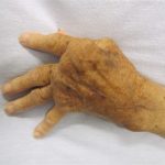 Deformidades en la artritis reumatoide