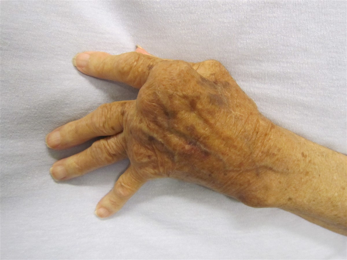Deformidades en la artritis reumatoide