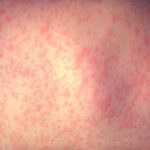 Exantema maculopapuloso causado por el virus de la rubeola