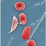 Globulos rojos de pacientes con Sicklemia