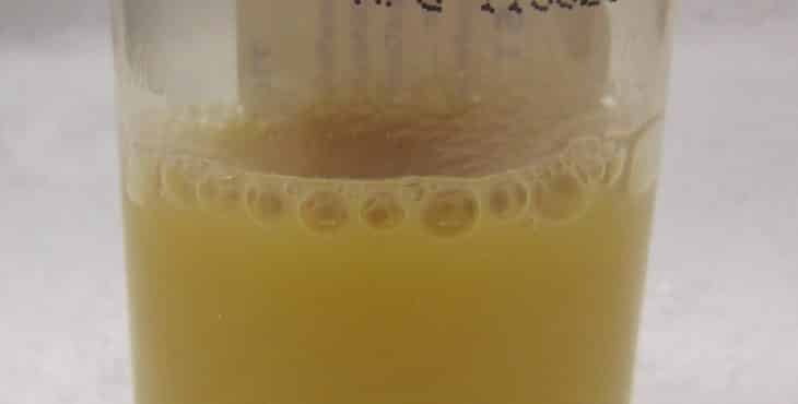 Las orinas turbias pueden ser expresión de infección en la orina