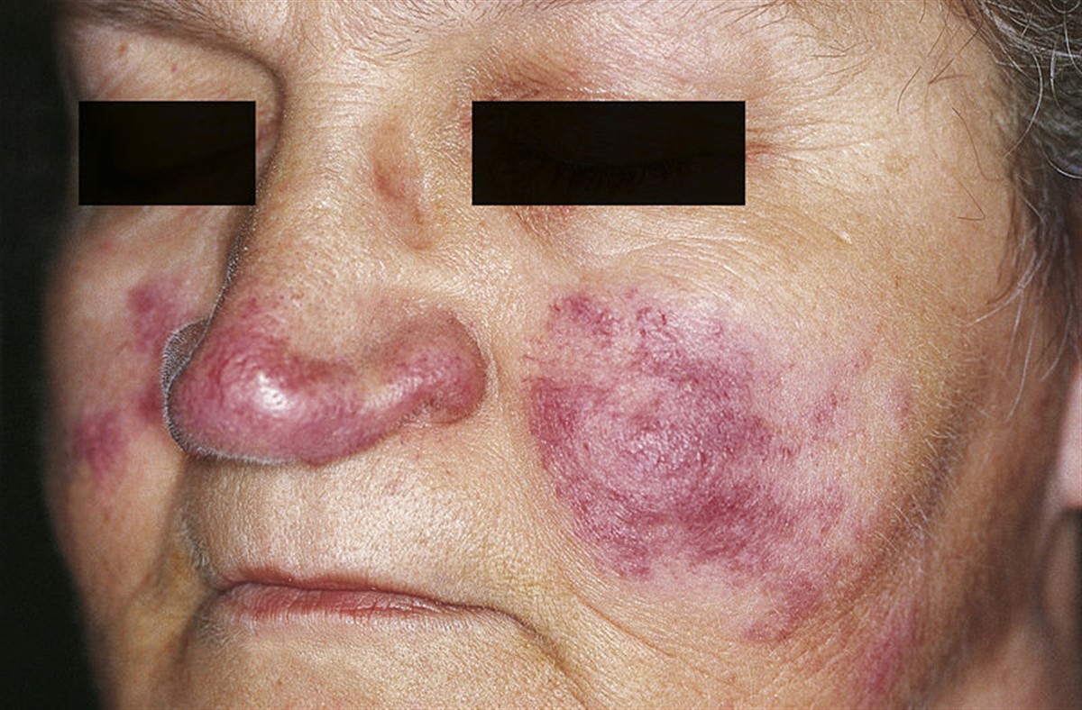 Lupus eritematoso sistémico y eritema facial