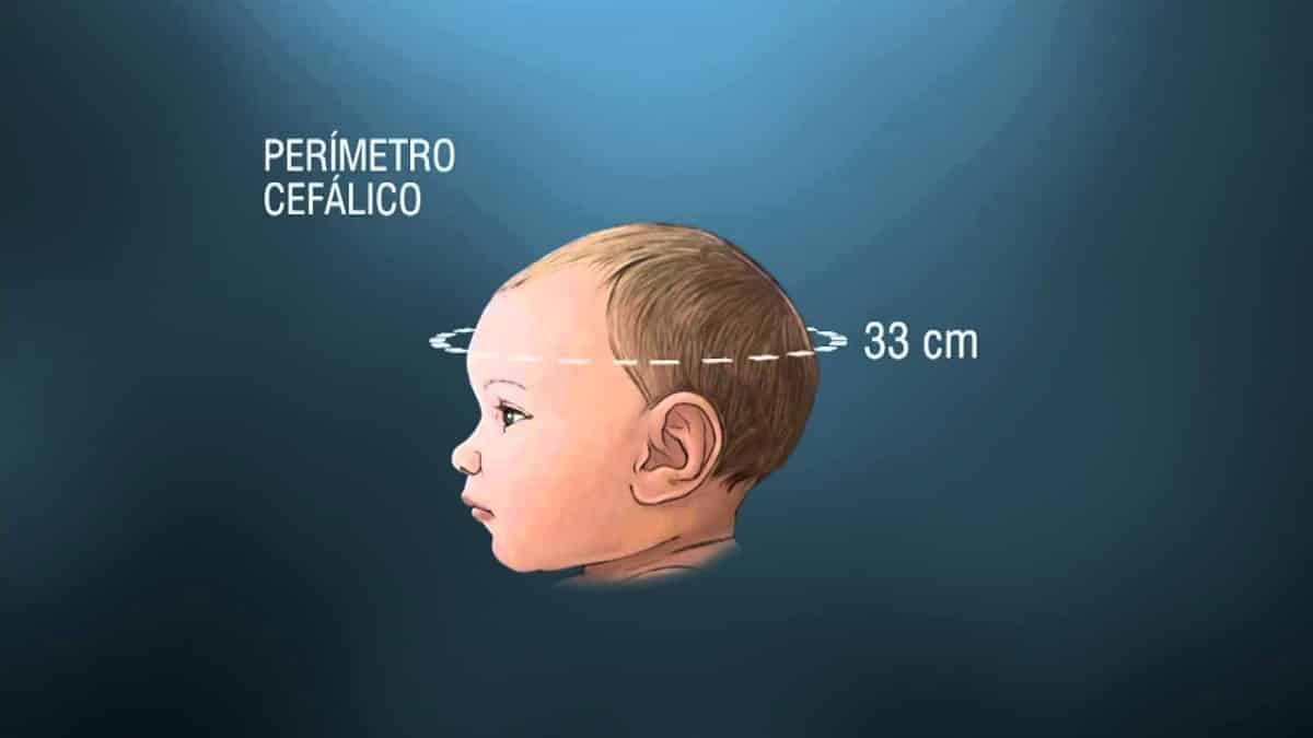 La Rubéola congénita es causa de microcefalia