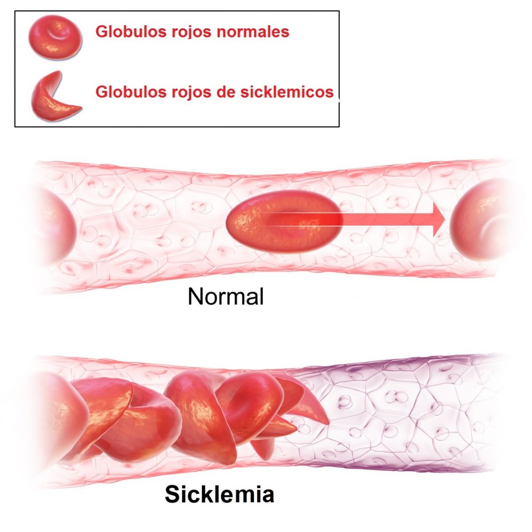 globulos-rojos-de-pacientes-con-sicklemia-actitud-saludable