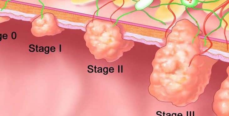 Pólipos adenomatosos en el colon y riesgo de cáncer de colon 