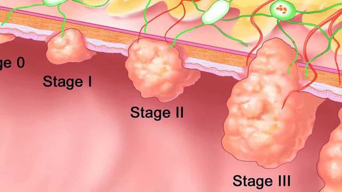 Pólipos adenomatosos en el colon y riesgo de cáncer de colon