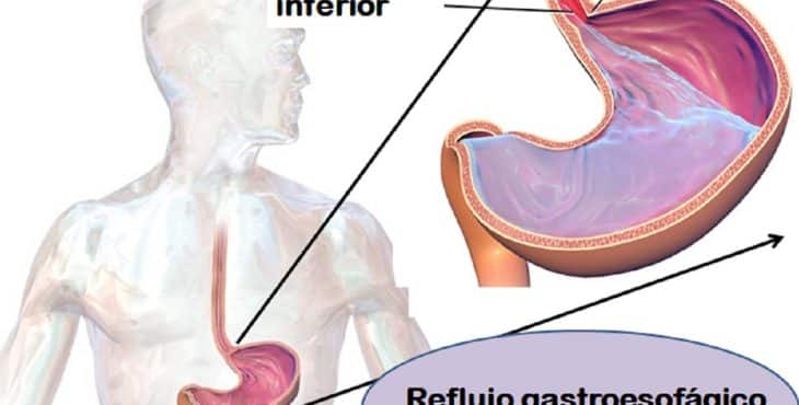 La acidez de estómago se puede producir por una alteración en el funcionamiento del esfínter esofágico inferior