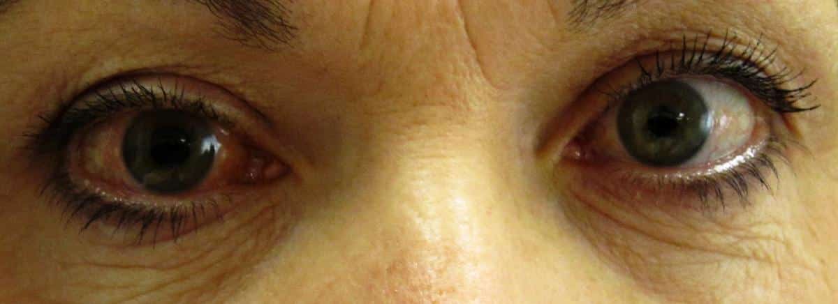 El glaucoma se presenta cuando aumenta la presión dentro del ojo.