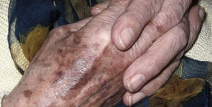 Las manchas de la edad son uno de los signos del envejecimiento de la piel