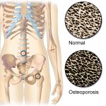 prevenir la osteoporosis Puntos frágiles de osteoporosis