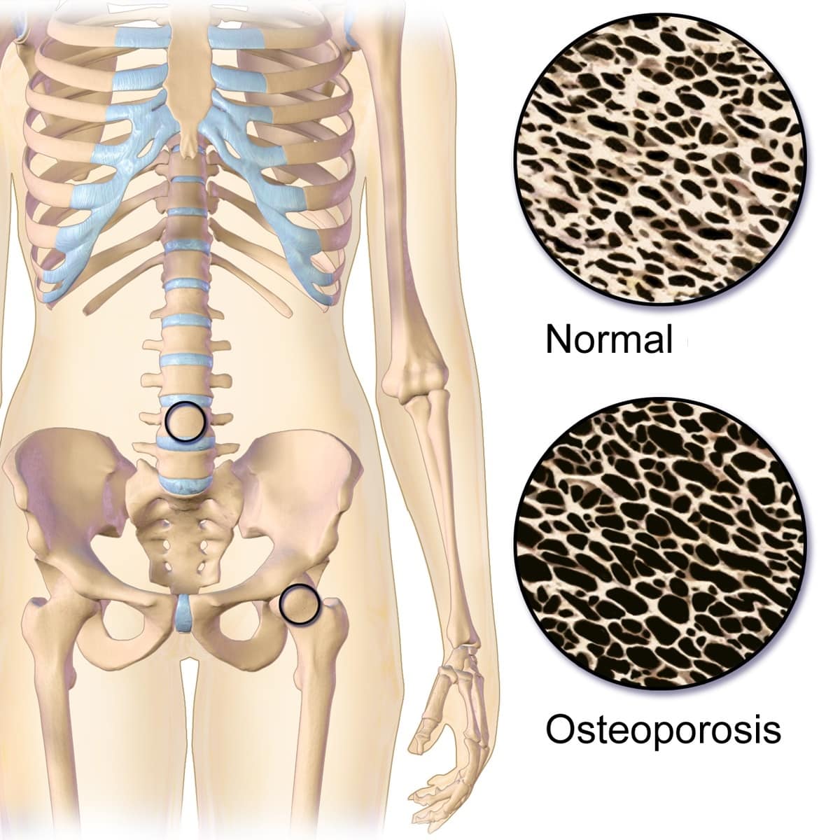 Áreas anatómicas donde se presenta la osteoporosis 