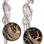 Sitios anatómicos preferenciales y manifestaciones de osteoporosis