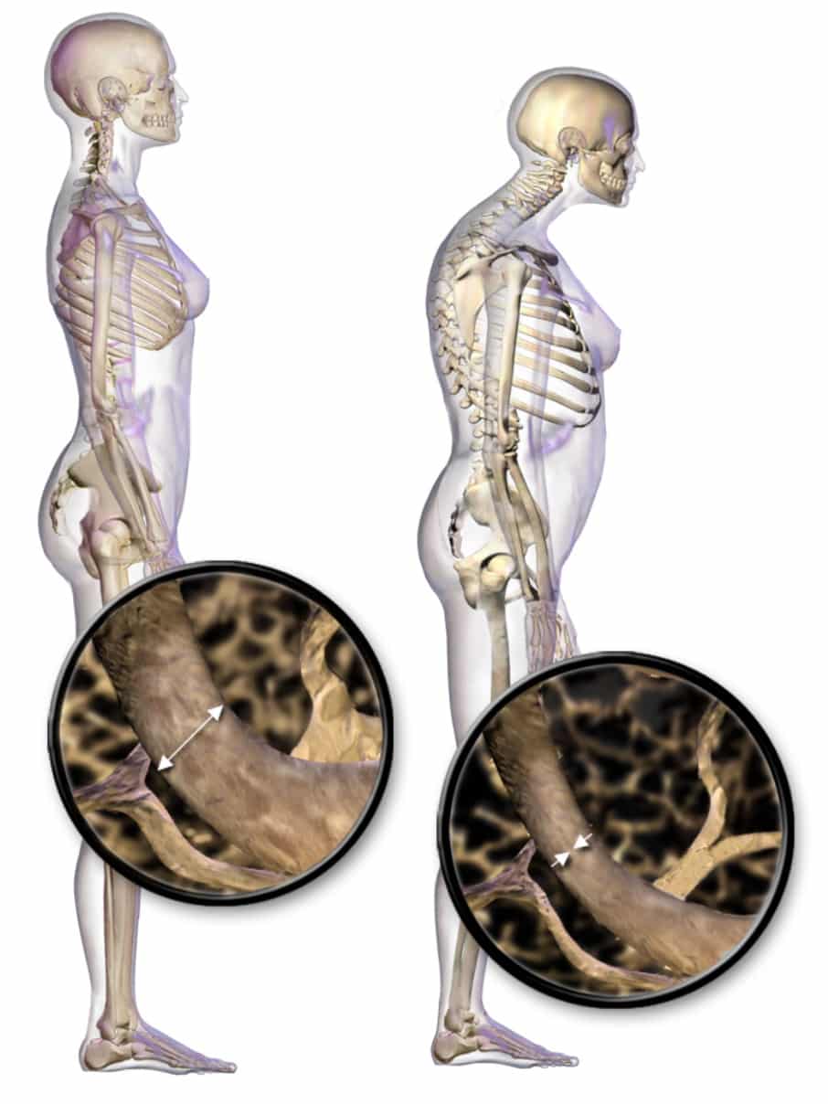 Localización de los puntos críticos donde se presenta la osteoporosis