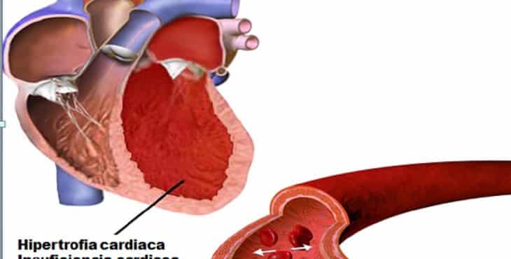 El hipertenso requiere atención médica sistemática